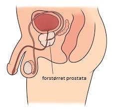 prostata illustrasjon